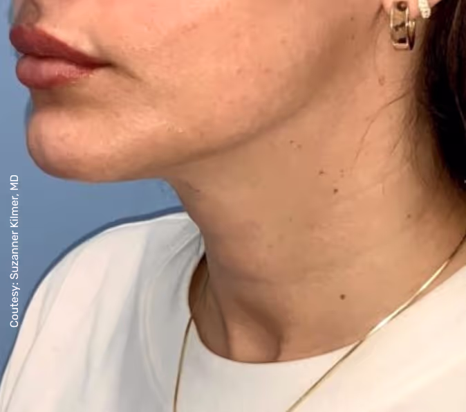 תמונה של אישה אחרי הטיפול