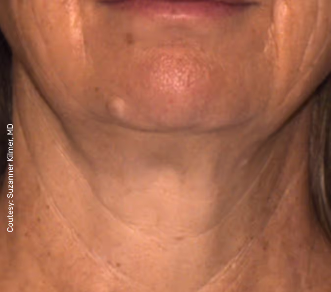 תמונה של אישה אחרי הטיפול